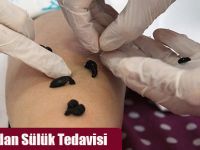 Doktorlardan Sülük Tedavisi
