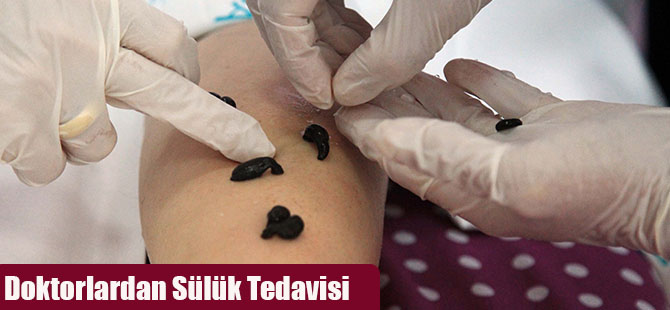 Doktorlardan Sülük Tedavisi