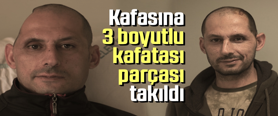 Kafasına 3 Boyutlu Kafatası Parçası Takıldı