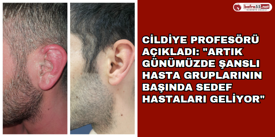 Cildiye profesörü açıkladı: "Artık günümüzde şanslı hasta gruplarının başında sedef hastaları geliyor"