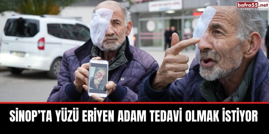 Sinop’ta Yüzü eriyen adam tedavi olmak istiyor