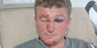 Balkondan düştü bu hale geldi