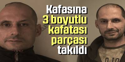Kafasına 3 Boyutlu Kafatası Parçası Takıldı