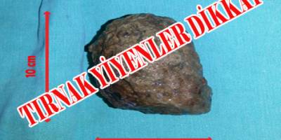 TIRNAK VE SAÇ YİYENLERDE 'BEZOAR' TEHLİKESİ